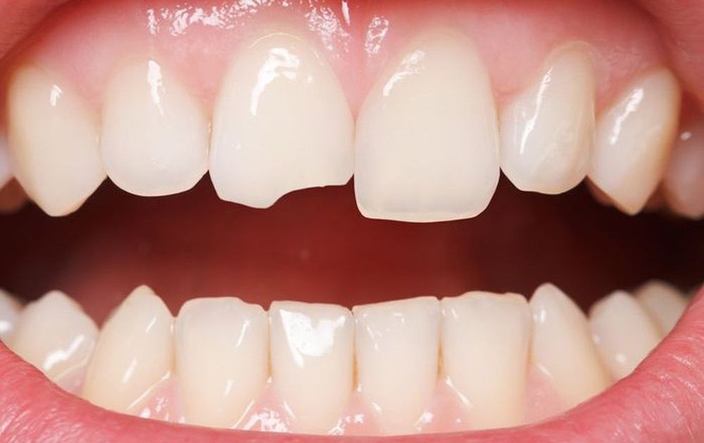 Răng sứt mẻ là tình trạng vô cùng phổ biến, nó làm tổn thương mô răng và có thể gây ra những biến chứng nguy hiểm