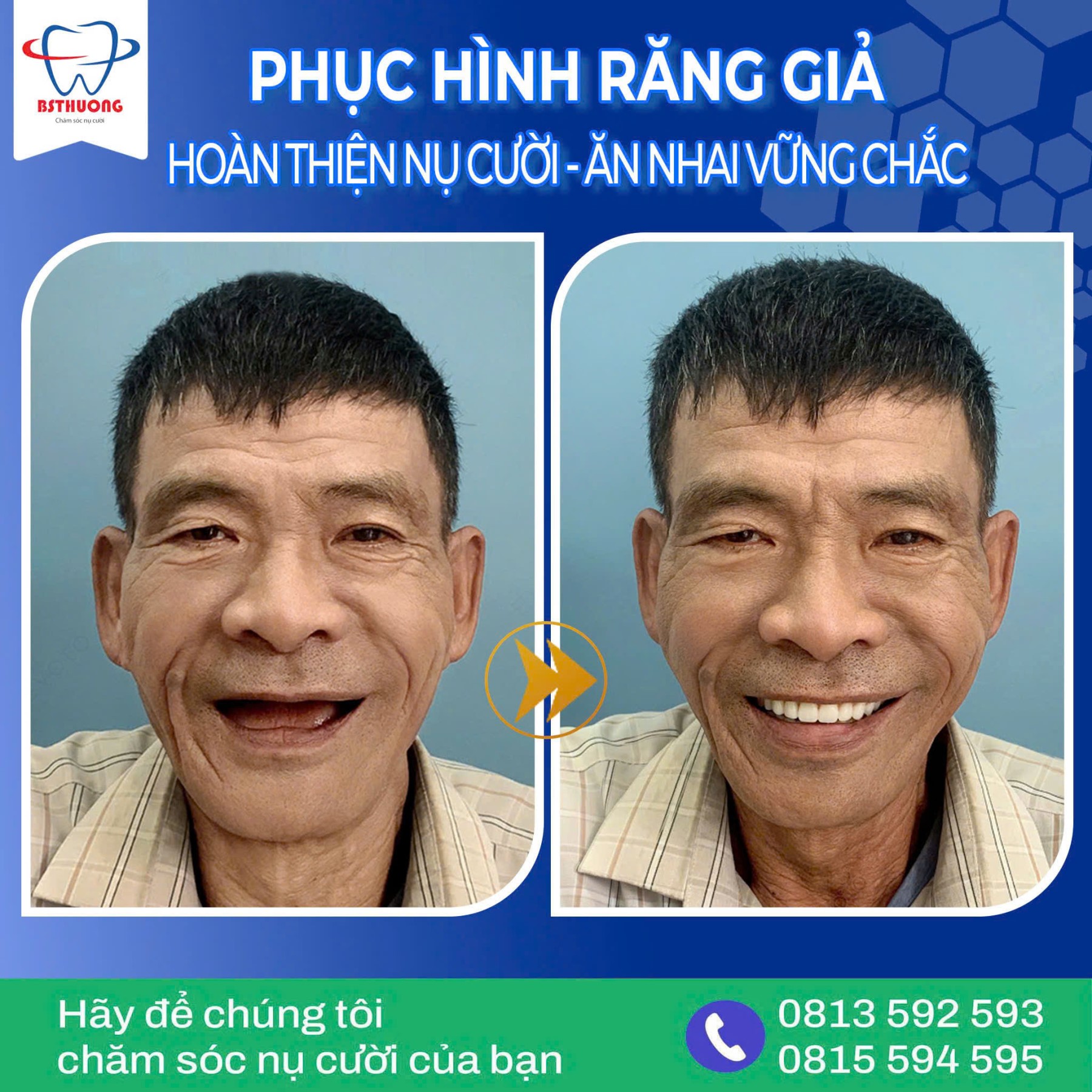 rang gia thao lap